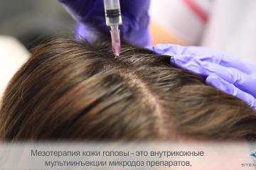 Мезотерапия и плазмотерапия – Лечение кожи головы