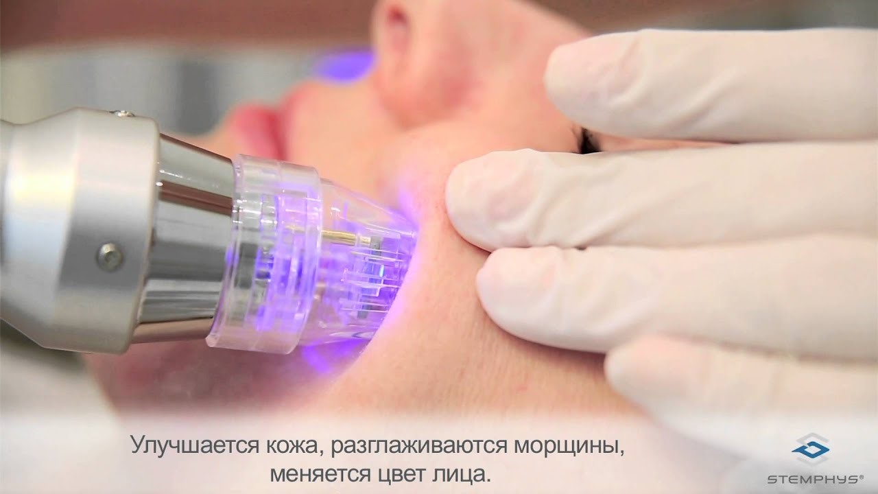 RF-перфорация как метод лечения акне.